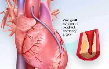 Coronary Artery Bypass Grafting (CABG)