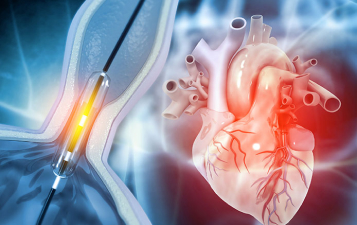Angioplasty & Stent Placement