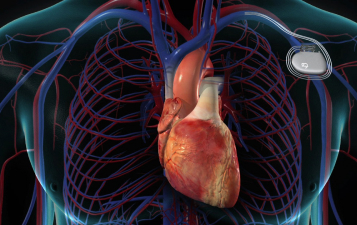 Pacemaker or ICD Implantation