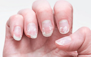 Nail Disorders