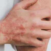 Persistent Skin Issues