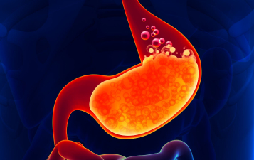 Gastroesophageal reflux disease (GERD)