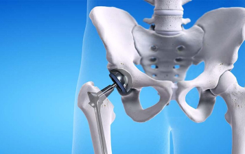 Hip Replacement Surgery