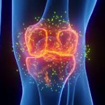 Severe Arthritis Symptoms