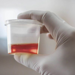 Blood in Urine (Hematuria)